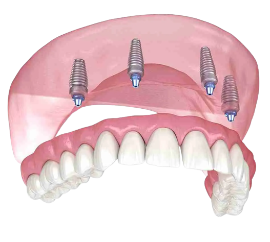 Willow Grove Dental Implants Center - 4 Implant Denture