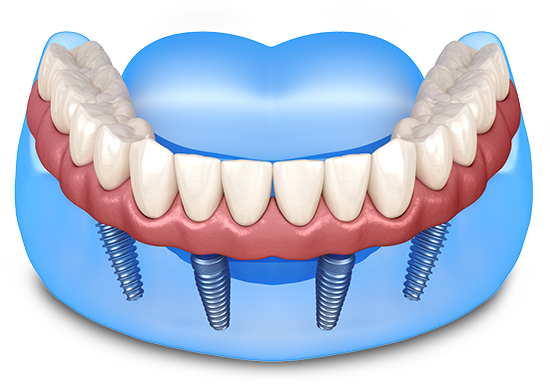 Willow Grove Dental Implants Center - Full arch implants graphic